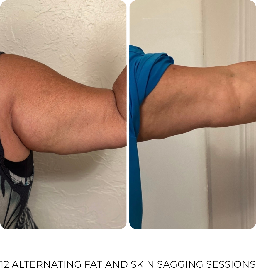 Artemis with 12-sessions-alternating-fat-and-skin-sagging-treatments